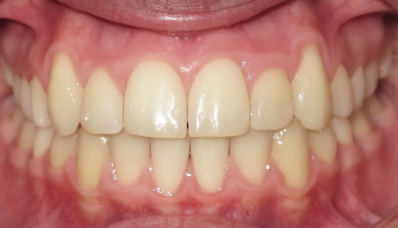 Afterteeth1. Jpg