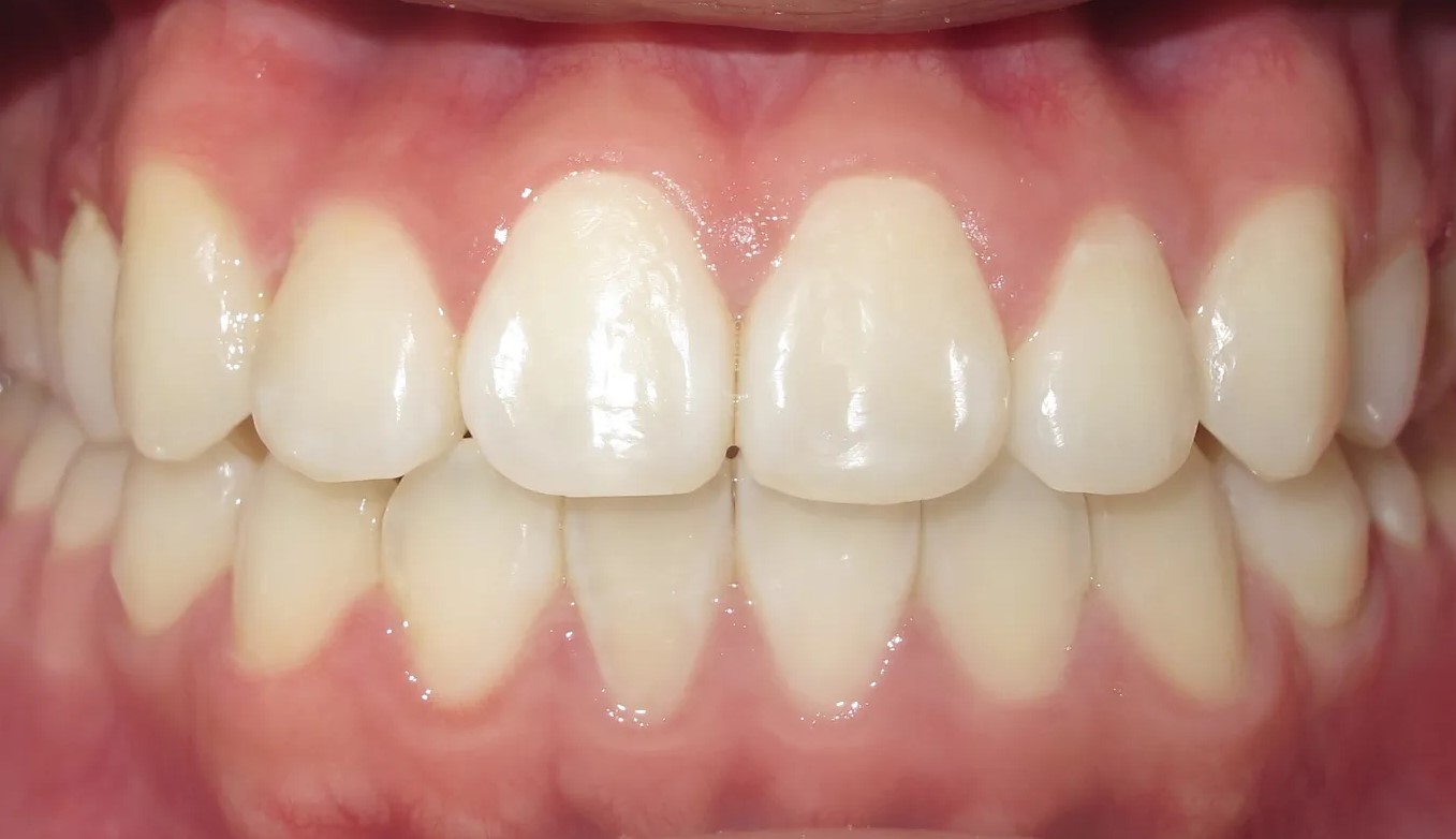 Teeth whitening