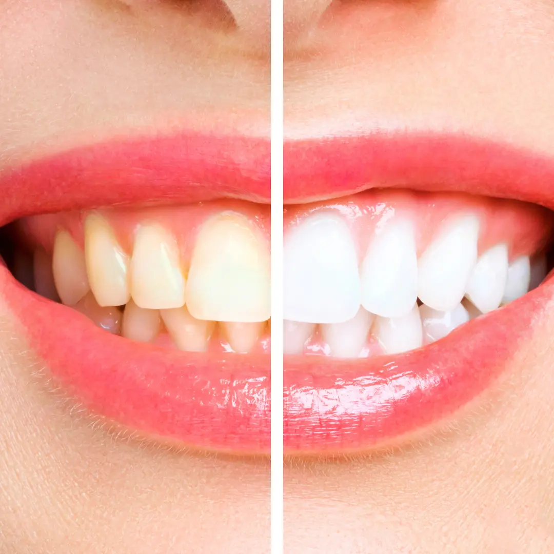 Best way to whiten teeth